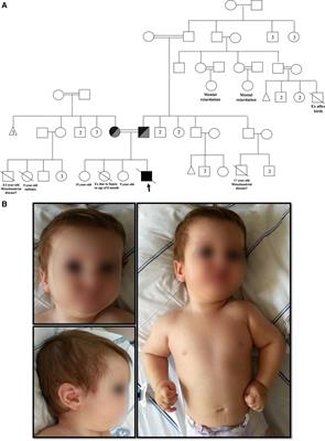 Case report: Artemis deficiency and 3M syndrome—coexistence of two distinct genetic disorders